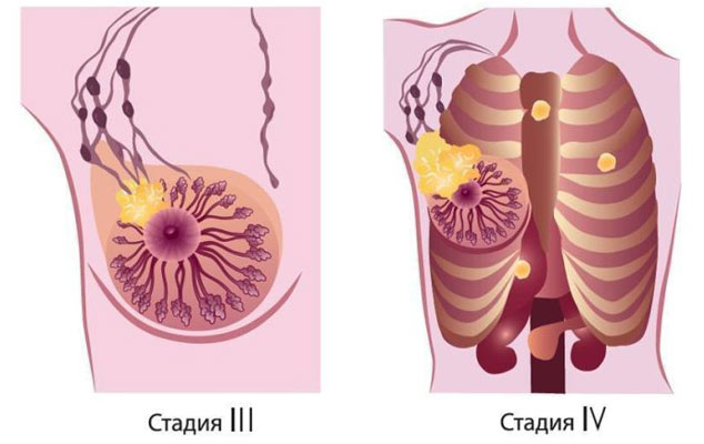 Рак молочной железы лечение